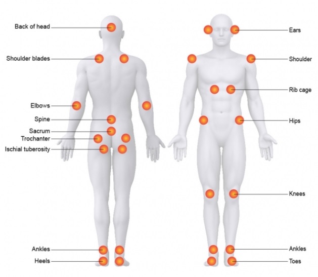 Recognizing And Treating Pressure Sores - MSKTC