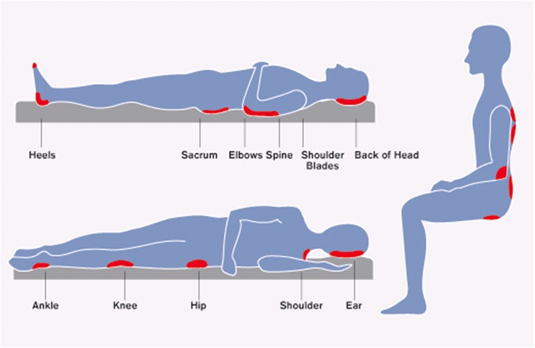 Pressure Ulcer Diagram